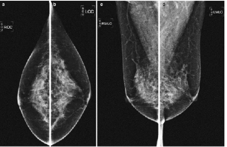 Figure 1.8 Routine screening mammography standard views. In order: Right CC, Left CC, Right MLO, Left  MLO 