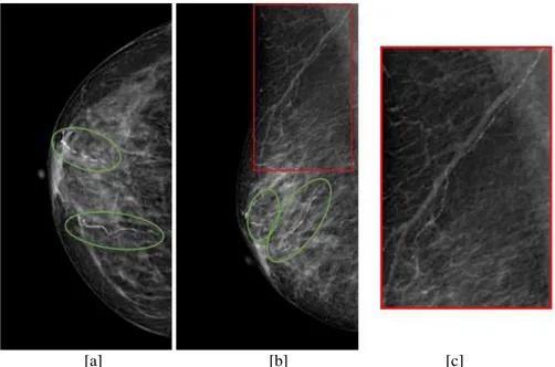 Figure 1.12 BACs on right CC and MLO views. Right CC [a], Right MLO [b] views of the same breast with  severe very evident BACs