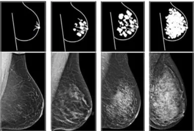 Figure 1.13 Effect of breast density on digital mammography visualization. From less dense breast (first on  the left) to the densest (last on the right) [www.mayo.edu] 