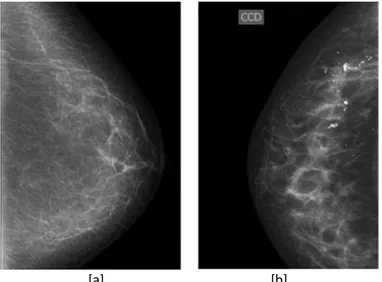 Figure 1.15 Examples of microcalcifications on mammogram. Round microcalcifications diffusely distributed  within the breast (little white spots) [a] Regional distribution [b]