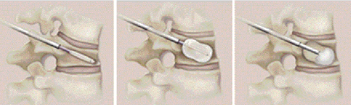 Figura 7 Chifoplastica: fasi di inserimento del palloncino di materiale polimerico nel corpo vertebrale 
