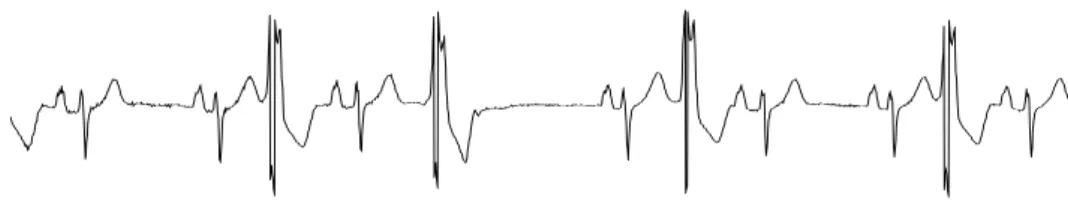 Figure 1.5 ECG of a patient in sinus rhythm with PVCs 