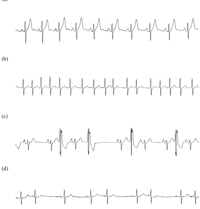 Figure 2.1 ECGs from four patients of the UVa Holter database in NSR (a), AF (b), SR with PVCs (c)  and SR with PACs (d)