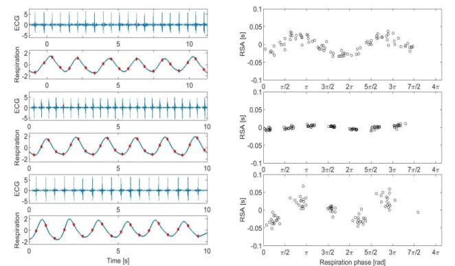 Figure 1-6: Example of presence of RSA and phase locking. On the left there are three 10 seconds segments of  ECG and breathing, and on the right the corresponding values of RSA and distribution of R peaks occurrence  with respect to respiratory phase