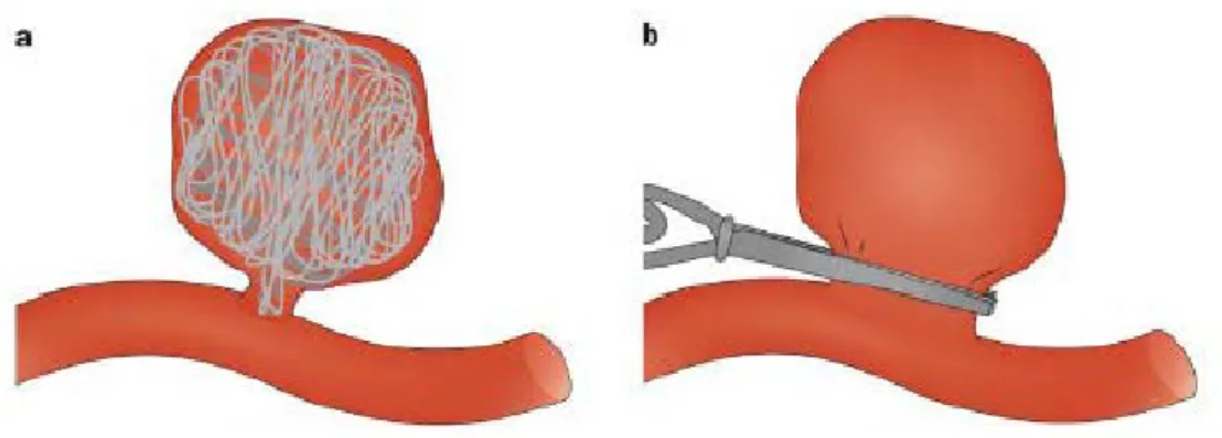 Figura 9 Tecniche chirurgiche per aneurisma cerebrale. 