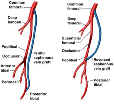 Figura 11 Esempi di posizionamento di bypass in seguito ad occlusioni di vasi sanguigni