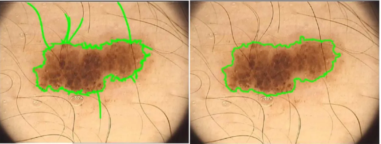 Figure 8: Segmentation without hair removal     Figure 9: Segmentation with hair removal 
