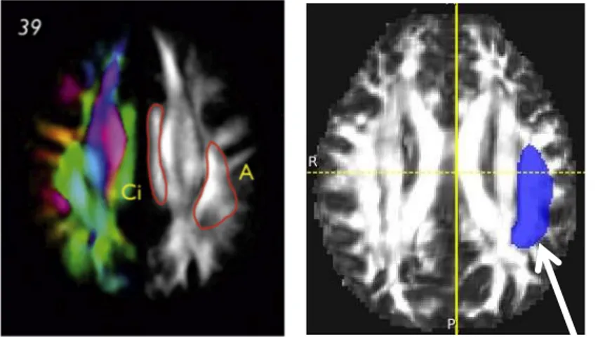 Fig. 2.2.1.1. ROI trasversale ( parte superiore ). A sinistra: una delle sezioni trasversali superiori della mappa  FA a colori, situata appena sopra il corpo del corpo calloso ( MNI 39 ) su cui è visibile la porzione  fronto-parietale ( A ) del fascicolo 