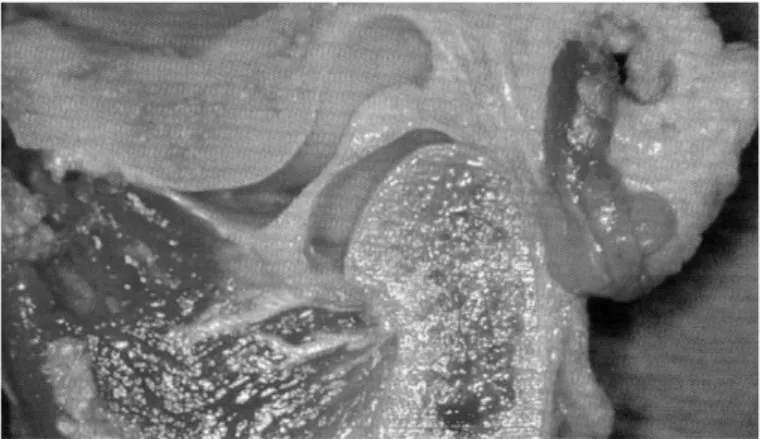 Figura 3 Disco articolare (Okeson J. Il trattamento delle disfunzioni dell’occlusione e dei disordini temporo- temporo-mandibolari)