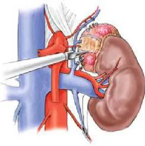 Fig. Resezione del tumore del polo superiore e inferiore. La porzione centrale della ghiandola viene preservata con  l’arteria media e i rami venosi 