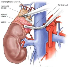 Fig. Il polo inferiore è resecato dividendo le arterie media e inferiore. La vena surrenalica viene preservata 