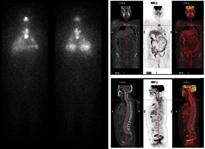 Figura 5. carcinoma poco differenziato con aree papillari solide, insulari, trabecolari del lobo 