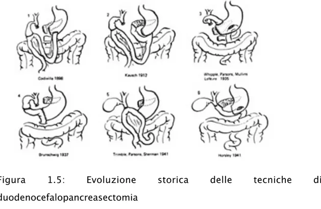 Figura  1.5:  Evoluzione  storica  delle  tecniche  di  duodenocefalopancreasectomia