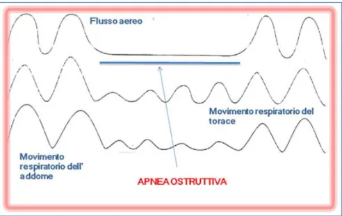 Figura 9. Andamenti del flusso aereo, movimento del torace e dell'addome durante l'apnea ostruttiva  (07) 