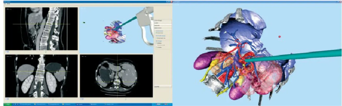 Fig. 1-3 GUI and virtual scenario of the EndoCAS laparoscopy navigator 