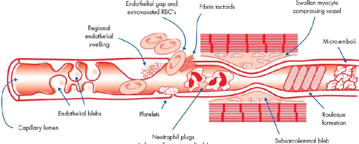Fig. 3  Patogenesi del no-reflow 