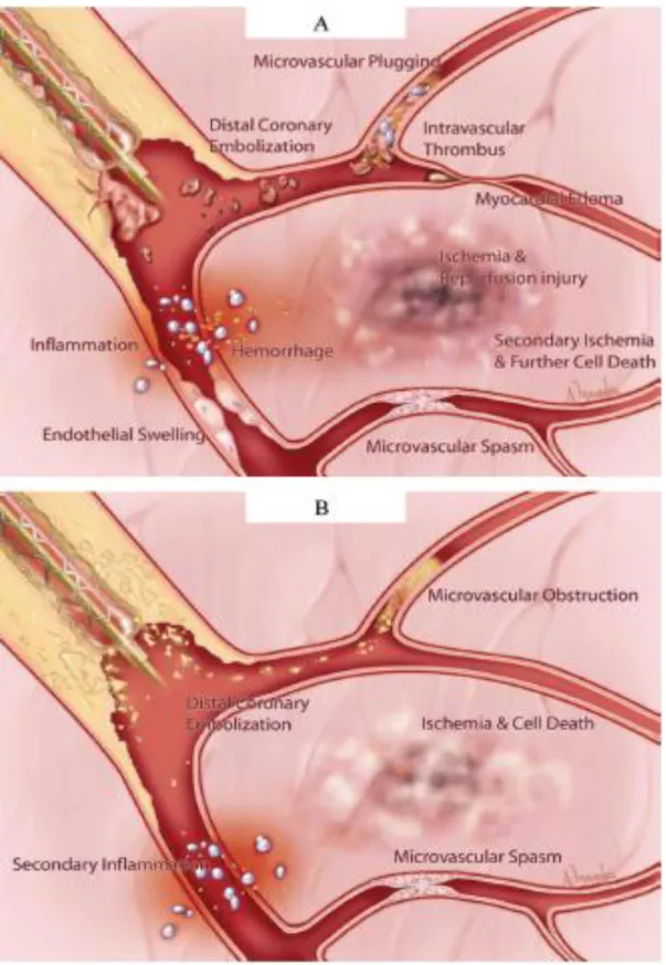 Fig. 7 Embolizzazione distale durante PCI 