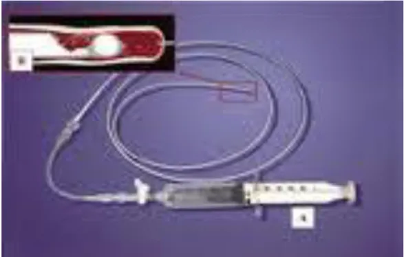 Fig.  9  Export  Catheter .(A)  Il  catetere  da  aspirazione  Export  con  siringa  overlocked
