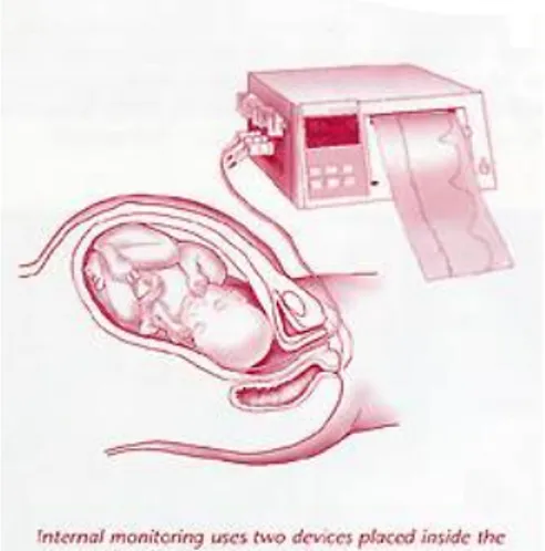 Figura 8. Cardiotocografia esterna ed interna 
