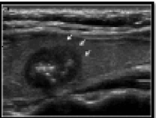 Figura 5: Immagine ecografica di una donna di 55 anni con CMT. Si può osservare la  marcata ipoecogenicità, la forma irregolare e le calcificazioni interne.
