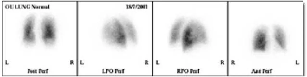 Figure 2. Tc-99m perfusion scan. 