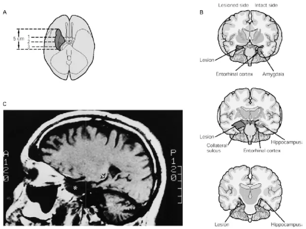 Figura 0-2  Immagine del cervello del soggetto HM