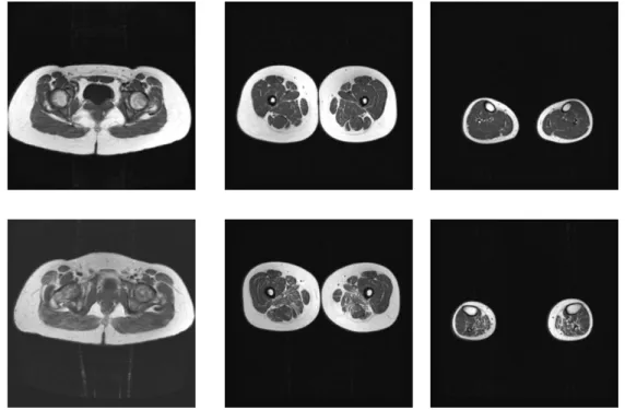 Figura 3.3 Immagini di Risonanza Magnetica Muscolare nei due pazienti affetti da Disferlinopatia 