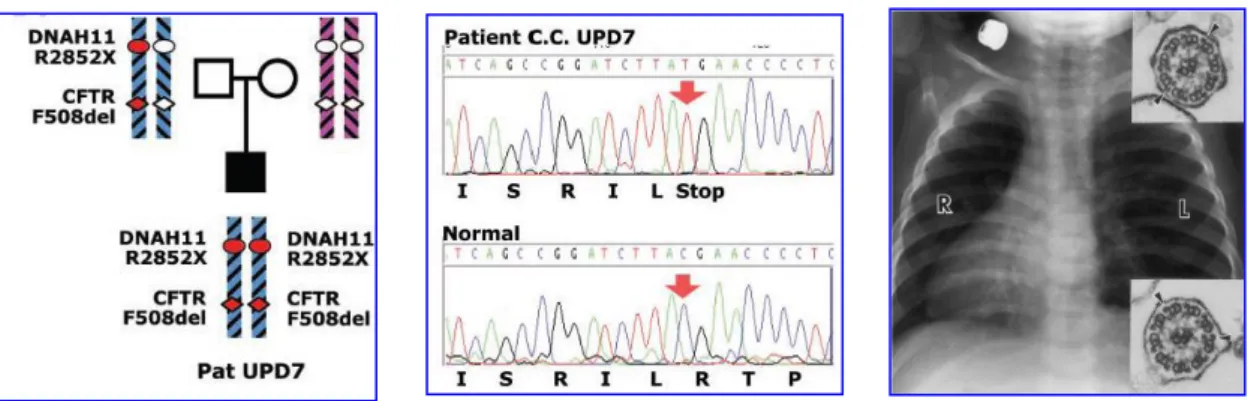 Figura 7. (A) Albero genealogico del paziente con UPD7 e rappresentazione  schematica di parte del cromosoma 7 con mutazioni nei geni CFTR eDNAH11 (alleli  mutanti in rosso, alleli normali in bianco)