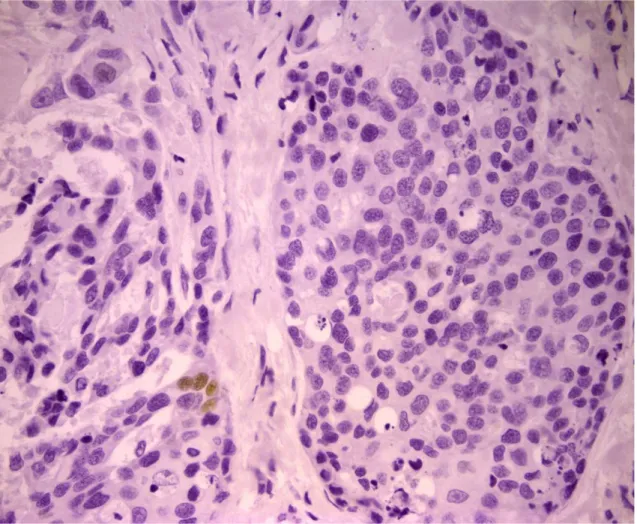 Figura 3:  Espressione  della  proteina  p63  in  carcinoma  mammario  del  cane. 