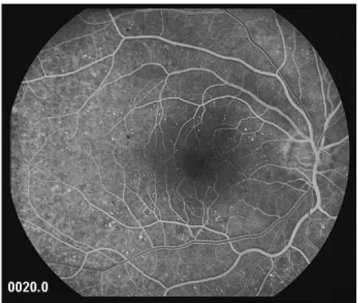 Figure 1.6: This image show the appearance of the ocular fundus in the rd1 mice retina.