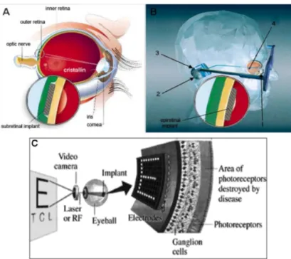 Figure 1.8: Schematic representations of subretinal (A) and epiretinal electronic implants (B): 1, camcorder mounted in a glass frame; 2, wireless transmitter;