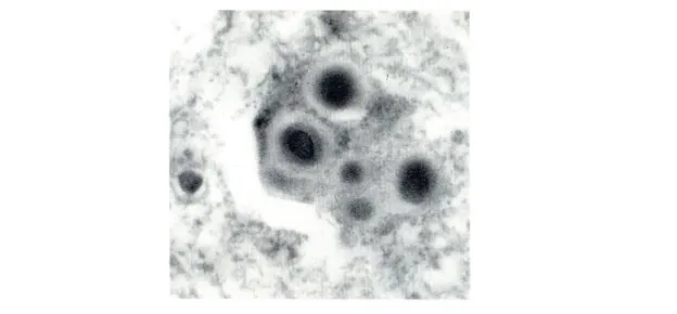 Figura 1 Immagine di microscopia elettronica di una cellula nervosa contenente corpi  di Lewy nel citoplasma.