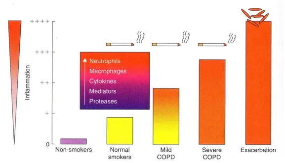 Figura  3.  Amplificazione  dell’infiammazione  polmonare  nella  BPCO.  I  fumatori  normali  hanno  una  risposta  infiammatoria  controllata,  che  rappresenta  la  normale  reazione della mucosa respiratoria agli stimoli irritanti cronici