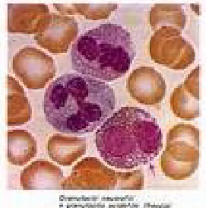 Fig. 1: striscio di sangue periferico con due granulociti neutrofili ed  un eosinofilo