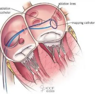 Figure 17 Pulmonary vein ablation 