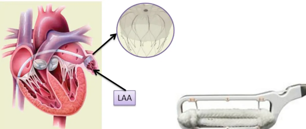 Figure 18 The Watchman® Left Atrial Appendage Filter System (left); The Gillinov-Cosgrove Clip*(right) 