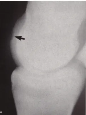 Fig.  9.  Frammentazione  osteocondrale  (Tipo  II)  (McIlwraith et al., 2005) 