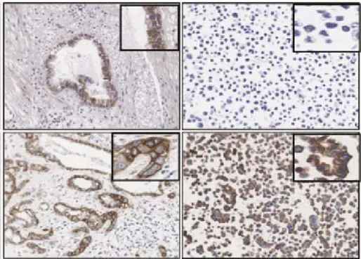 Figura 11. Esempi di immunoistochimica per EGFR (pannelli a sinistra) e controlli positivi e  negativi (pannelli a destra) 