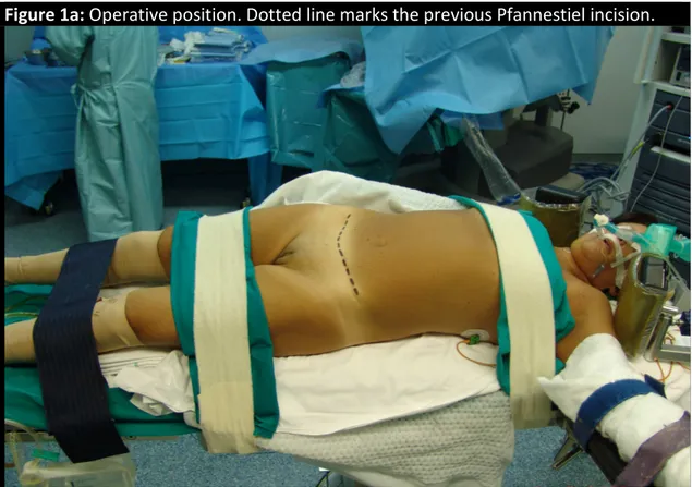 Figure 1a: Operative position. Dotted line marks the previous Pfannestiel incision. 