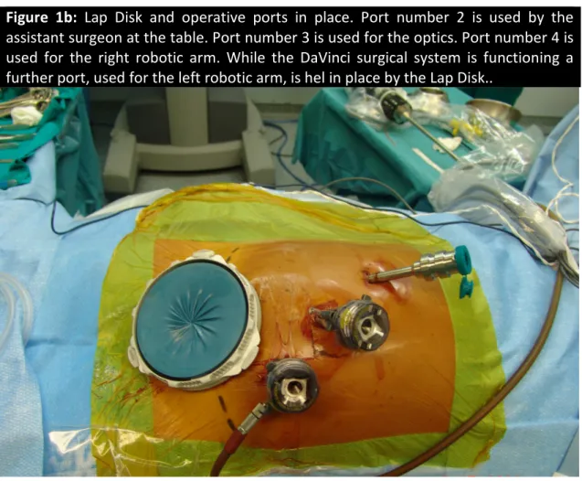 Figure  1b:  Lap  Disk  and  operative  ports  in  place.  Port  number  2  is  used  by  the  assistant surgeon at the table