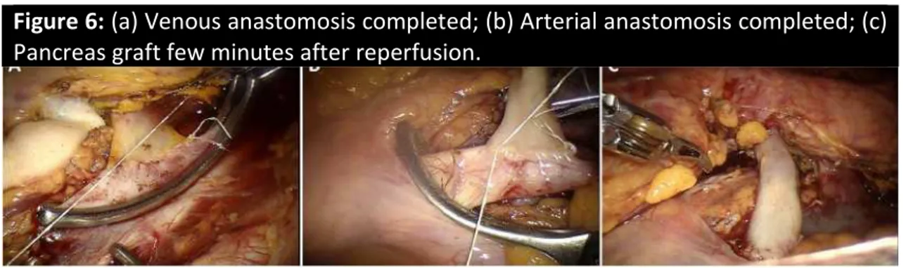 Figure 6: (a) Venous anastomosis completed; (b) Arterial anastomosis completed; (c)  Pancreas graft few minutes after reperfusion