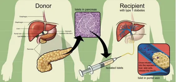 Figure 1. Islet transplantation. Islets were purified and infused via the portal vein of diabetic recipients,  once they were extracted and isolated from the pancreas