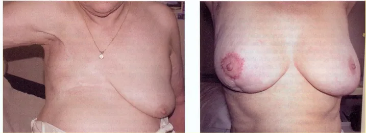 Figura  1.9  Terapia  chirurgica  del  carcinoma  mammario.  Asinistra  esito  di  mastectomia  radicale  modificata  secondo  Madden, a destra esiti della chirurgia conservativa