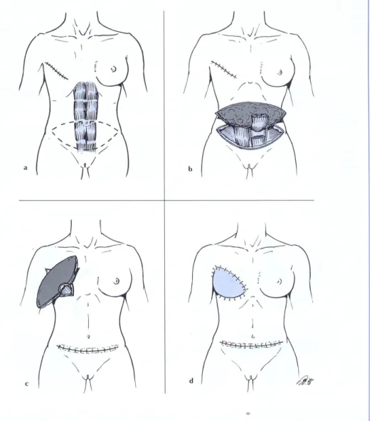 Figura 1.11 Ricostruzione della  mammella tramite trasposizione del  lembo  muscolo-cutaneo del retto addominale:  a-  incisione  della  cute  in  regione  ipogastrica,  b-  isolamento  del  muscolo,  c-  trasferimento  del  muscolo  in  regione  mammaria,