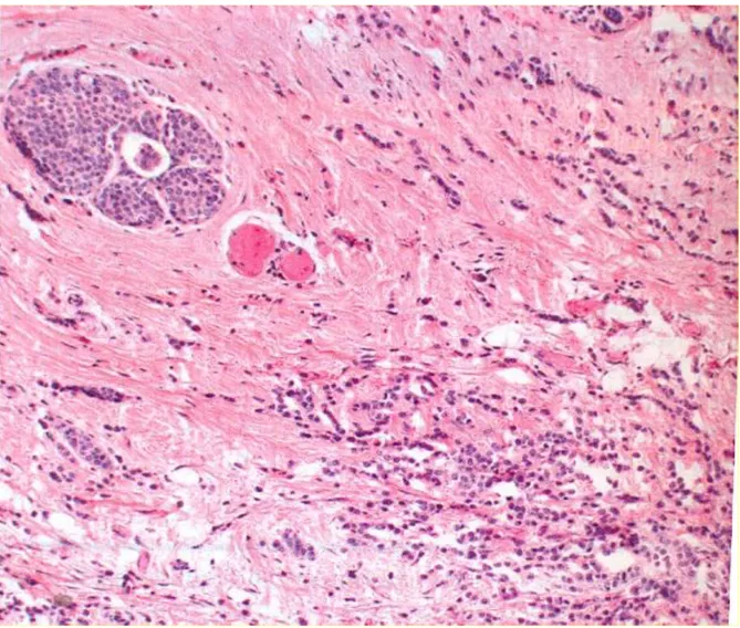 Figura 1.2 Carcinoma globulare invasivo. File parallele di piccole celluleregolari con scarso citoplasma che infiltrano  in file singole o come gruppetti di cellule
