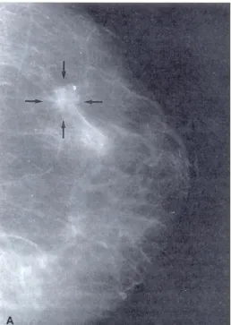 Figura 1.3 Mammografia che mostra un carcinoma duttale infiltrante. Si notano i margini irregolari  e la presenza di una piccola calcificazione