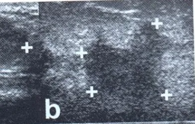 Figura 1.4 Ecotomografia che mostra un carcinoma mammario. 