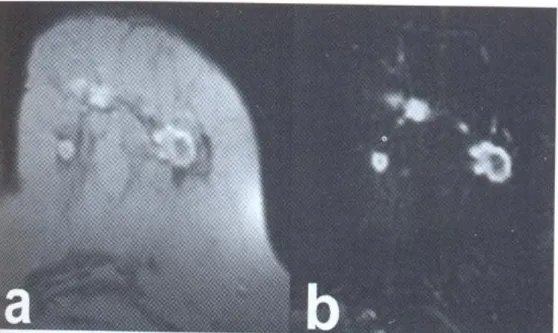 Figura 1.6 Risonanza magnetica in proiezione trasversale T1-pesata, a: subito dopo iniezione di mezzo di contrasto, b: 