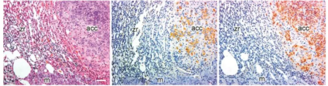 Fig  5.4.  Sezioni  istologiche  di  carcinomi  adrenocorticali  di  furetto:  si  nota  la  giunzione  tra  la  zona  reticolare  (zr)  e  quella  midollare  (m)