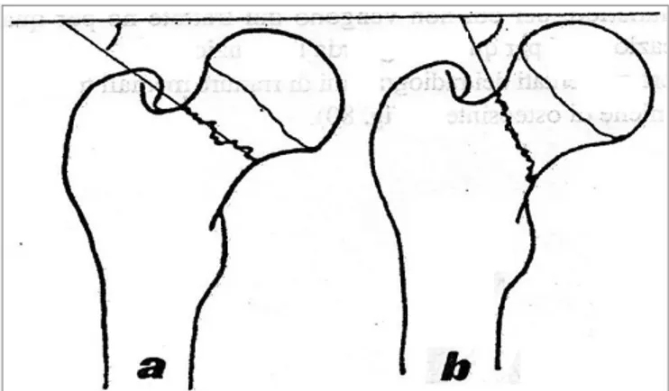 Figura 1.12: Schemi di metafisi superiore di femore con rima di frattura del collo   femorale